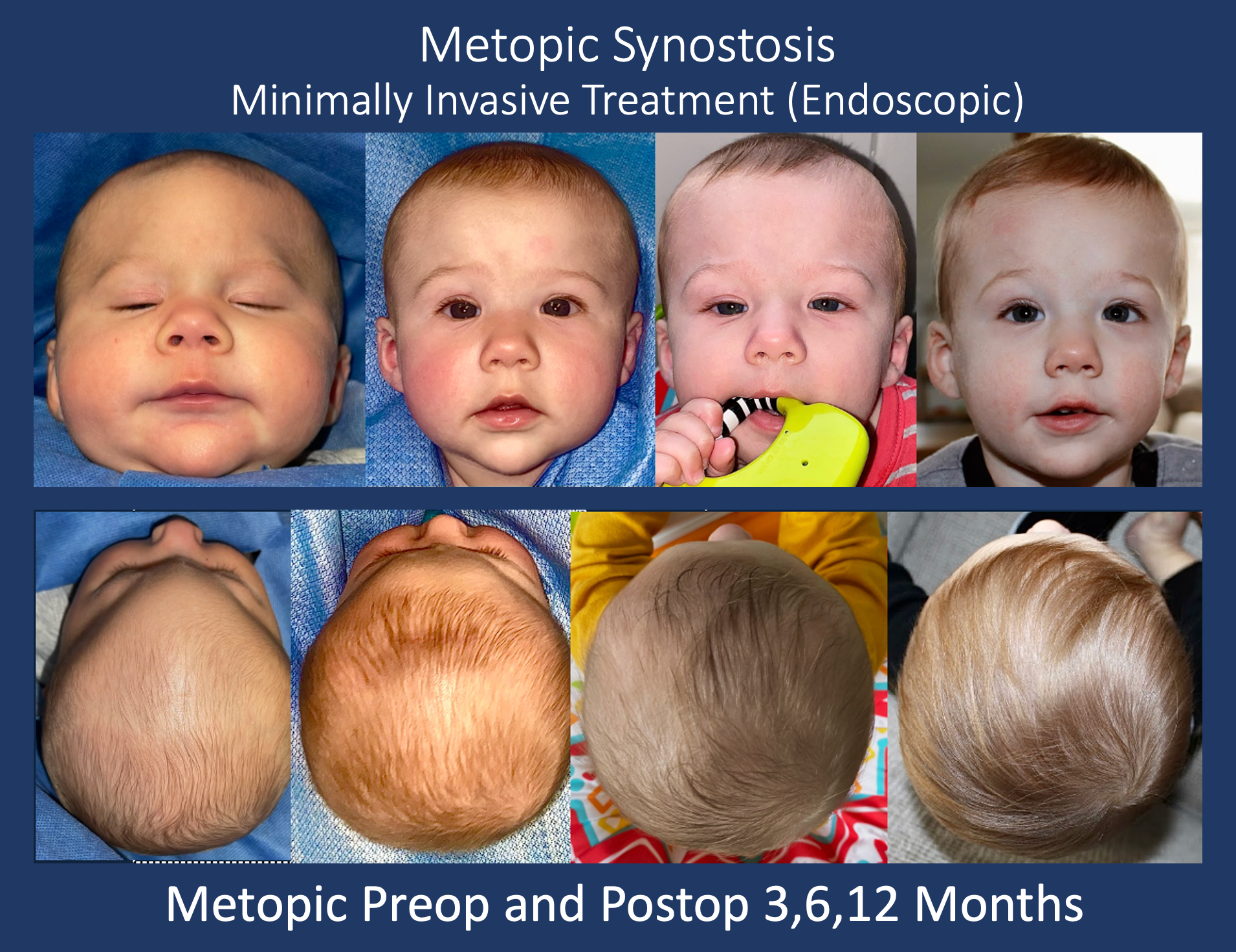 photo collage of metopic synostosis