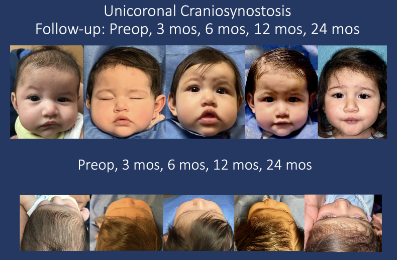 photo collage of unicorporal craniosynostosis, babies photos