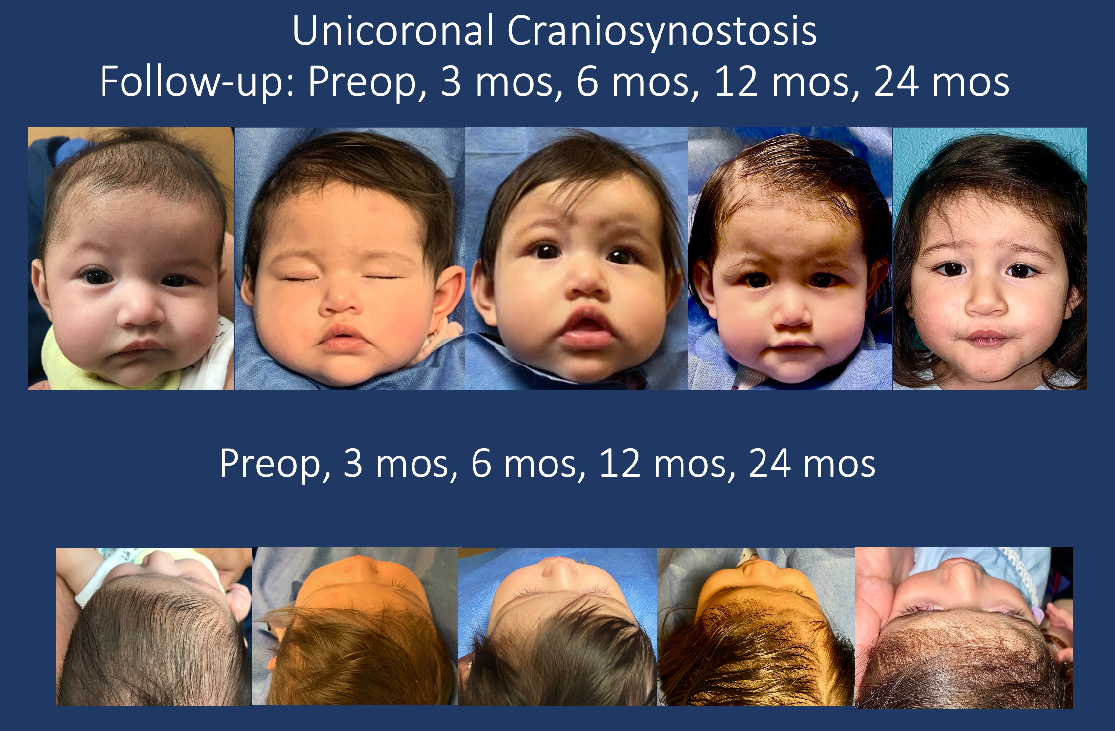photo collage of unicorporal craniosynostosis