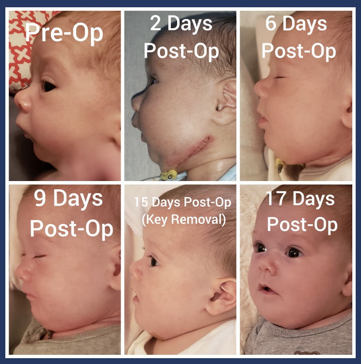 mandibular distraction surgery progress photos