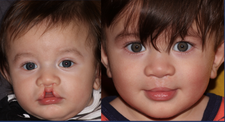 bilateral incomplete cleft palate before and after surgery