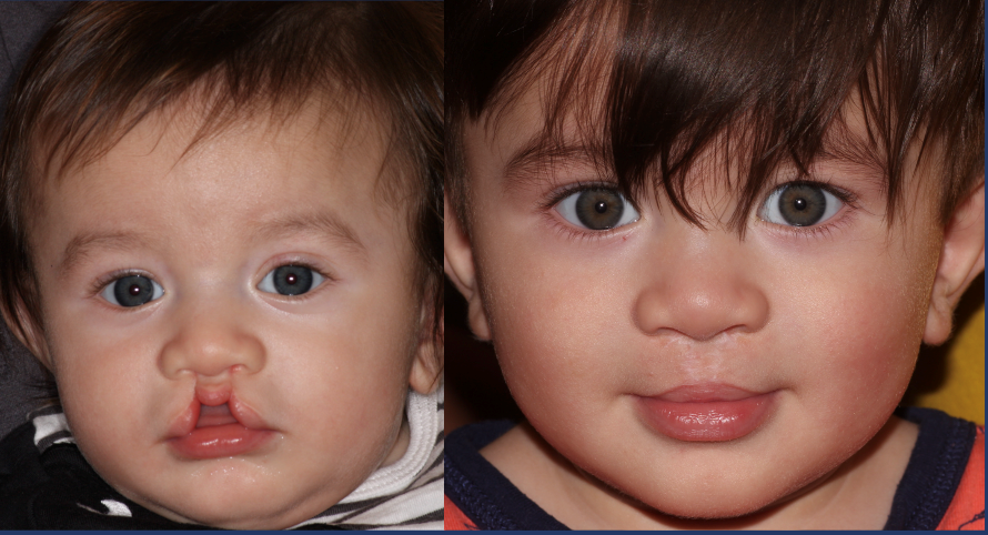 bilateral incomplete cleft palate before and after surgery