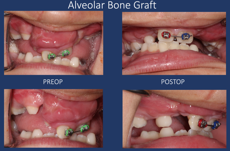 alveolar bone graft el paso texas