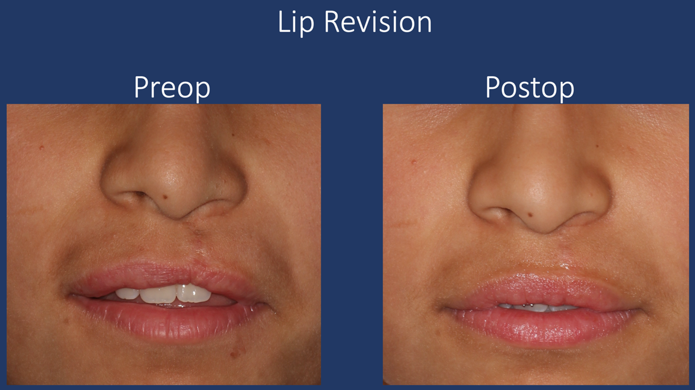 cleft lip revision before and after el paso tx