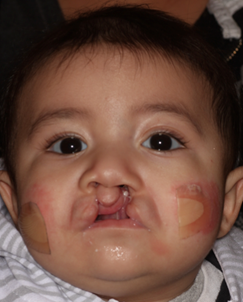 A young child before cleft palate surgery