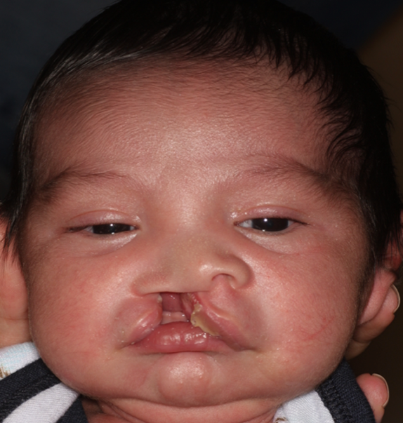 a baby with a cleft palate before receiving surgery