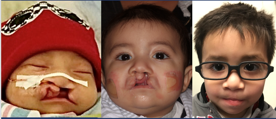 a 3-image progression of the healing of a cleft palate surgery