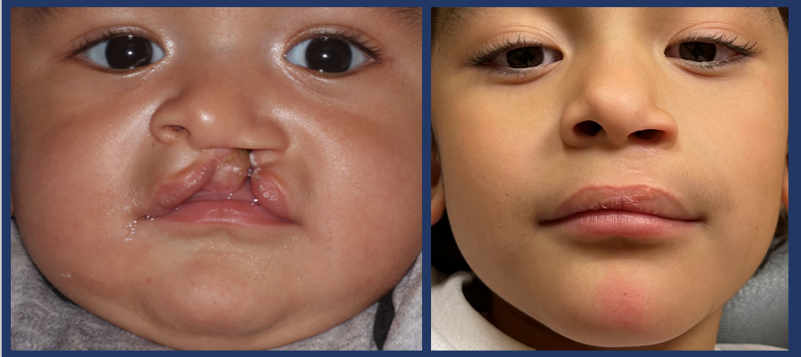 unilateral cleft palate surgery before and after in el paso tx