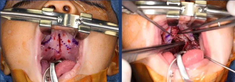 furlow palatoplasty el paso tx