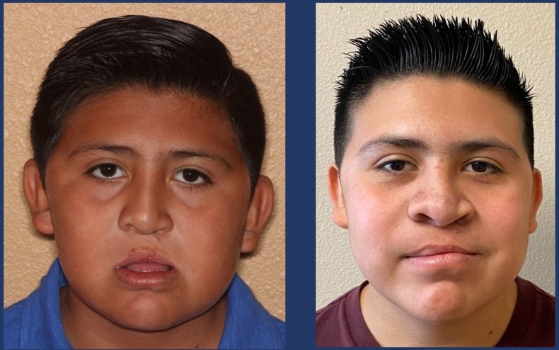 cleft jaw surgery before and after el paso tx