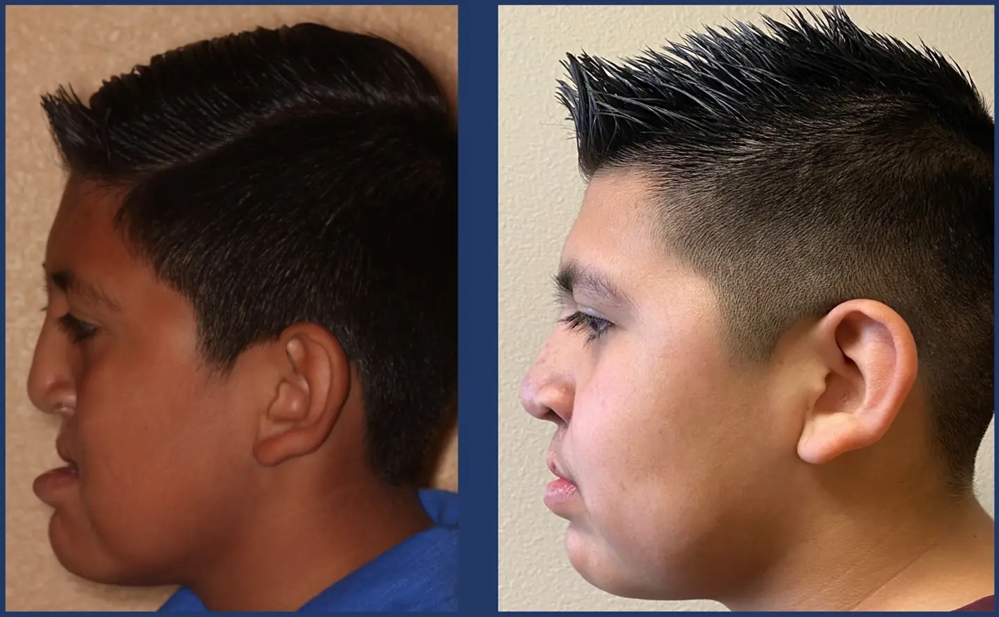 cleft orthognathic surgery before and after in el paso texas