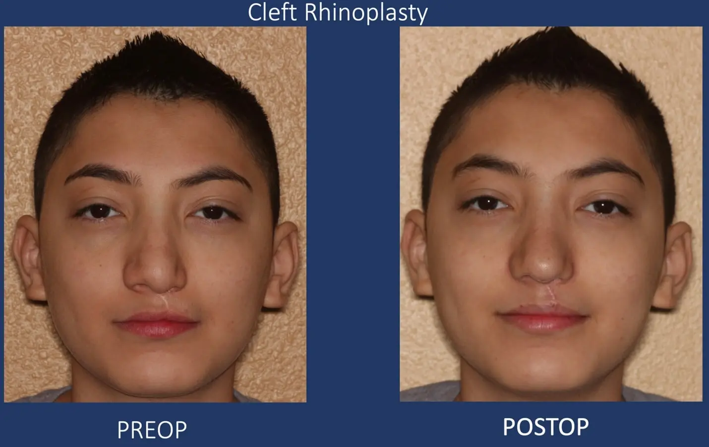 cleft rhinoplasty before and after