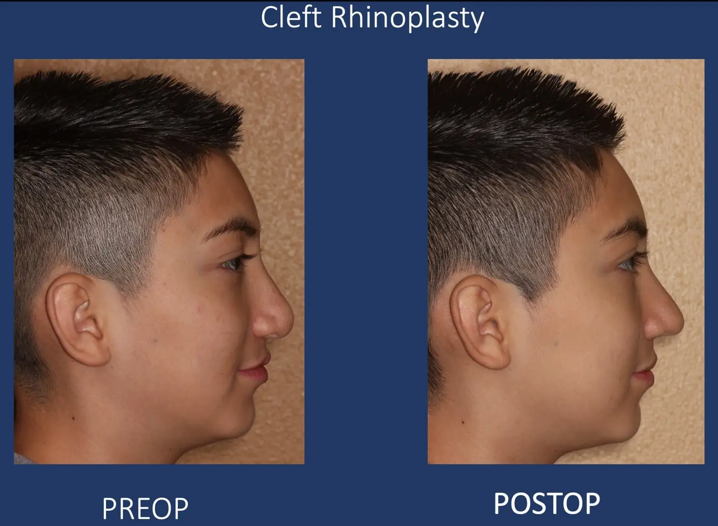 cleft rhinoplasty before and after in el paso tx